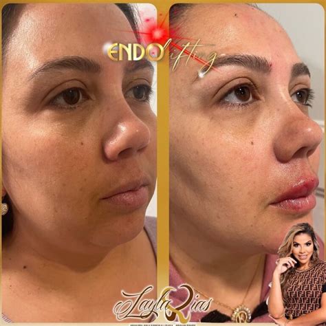 endolifting é perigoso